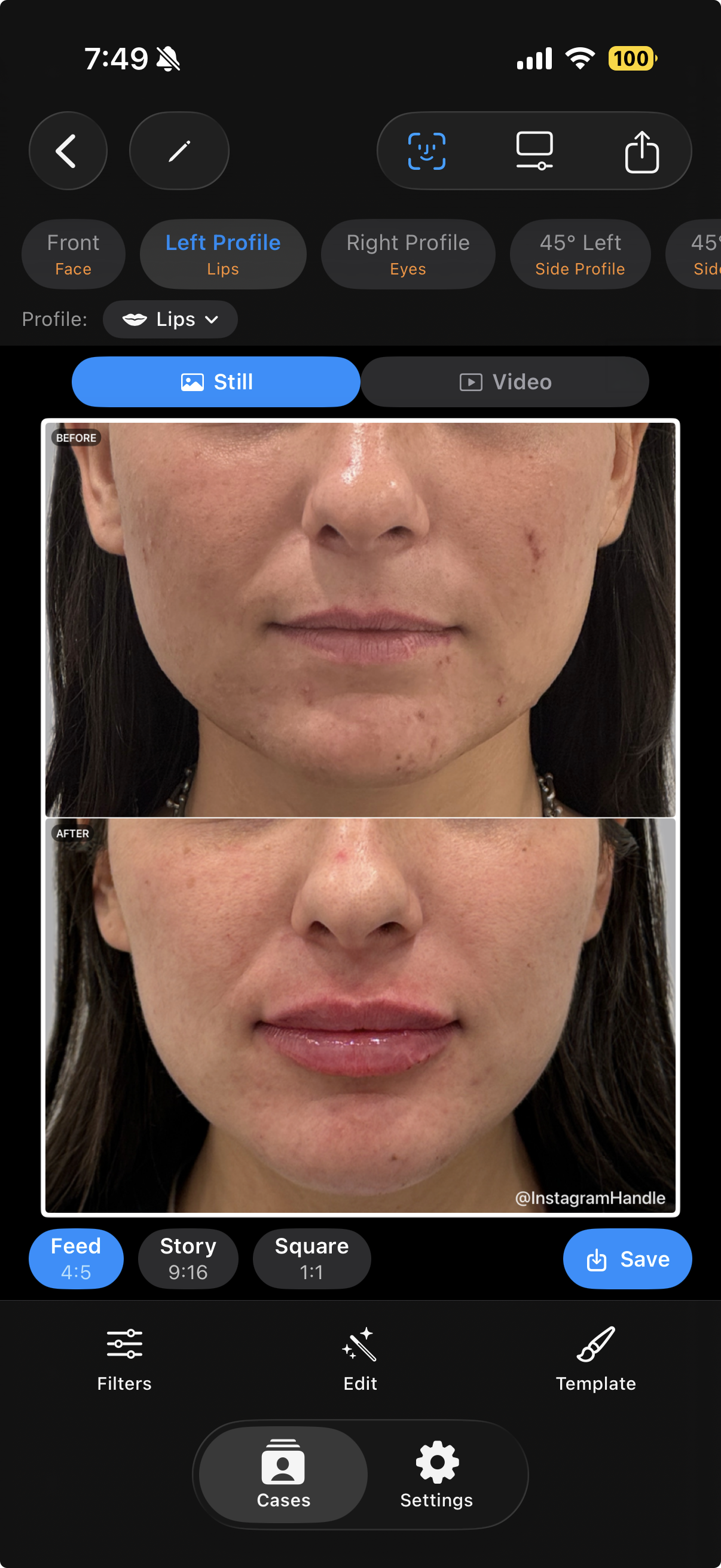 Multi-angle documentation with focused lips profile